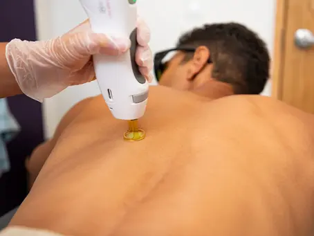 Full Back Laser Hair Removal in Shreveport and Bossier city
