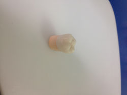 molar en zirconio maquillado