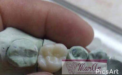 corona unitaria metal ceramica