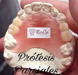 protesis transicional