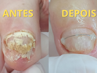 Unhas amareladas, espessas ou frágeis? Pode ser Onicomicose — e a Podólogoa Silvane Krug te ajuda a tratar!
