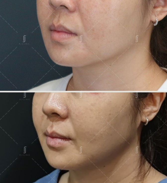 Double Chin Jawline Treatment by RJ Clinic