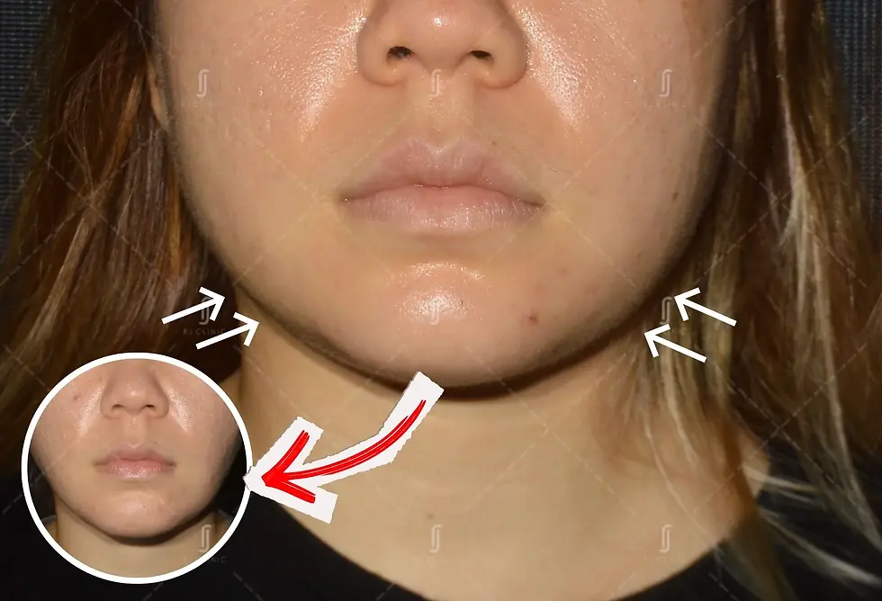 RJ Clinic V-shape face treatment in Kuala Lumpur showing jawline analysis and facial contour assessment