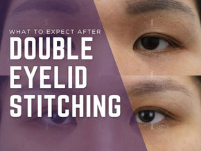 What to Expect After Double Eyelid Stitching: A Clinical Recovery Guide