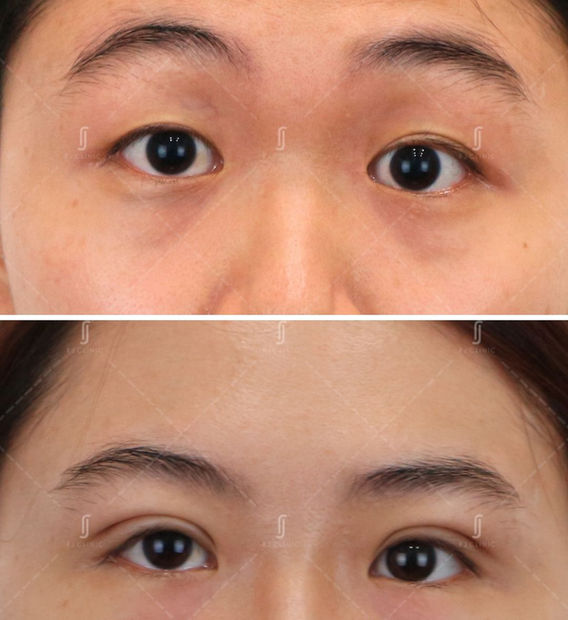 Plexr plasma double eyelid tightening treatment at RJ Clinic