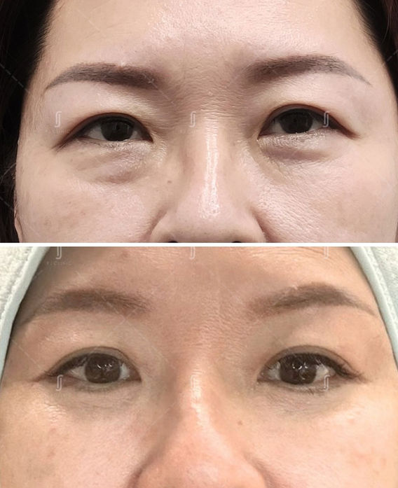 Before and after eye bag removal surgery at RJ Clinic Malaysia – female patient with smoother under-eye area and lifted lower lids.