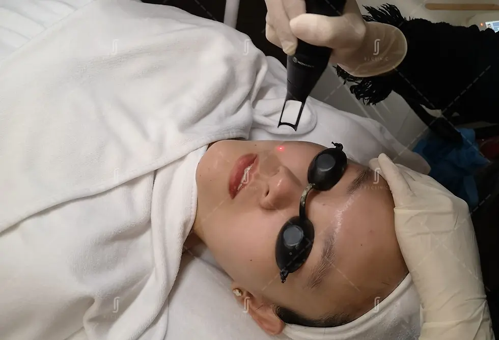 Fractional laser acne scar treatment procedure at RJ Clinic Malaysia for skin resurfacing