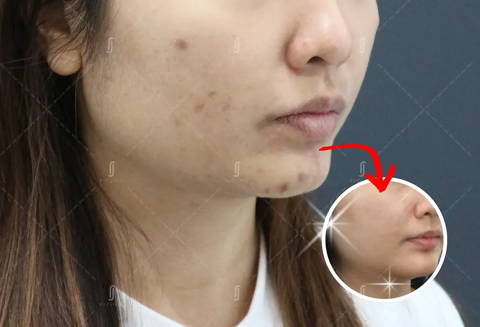 Before and after acne scar laser treatment results at RJ Clinic Malaysia showing smoother skin texture