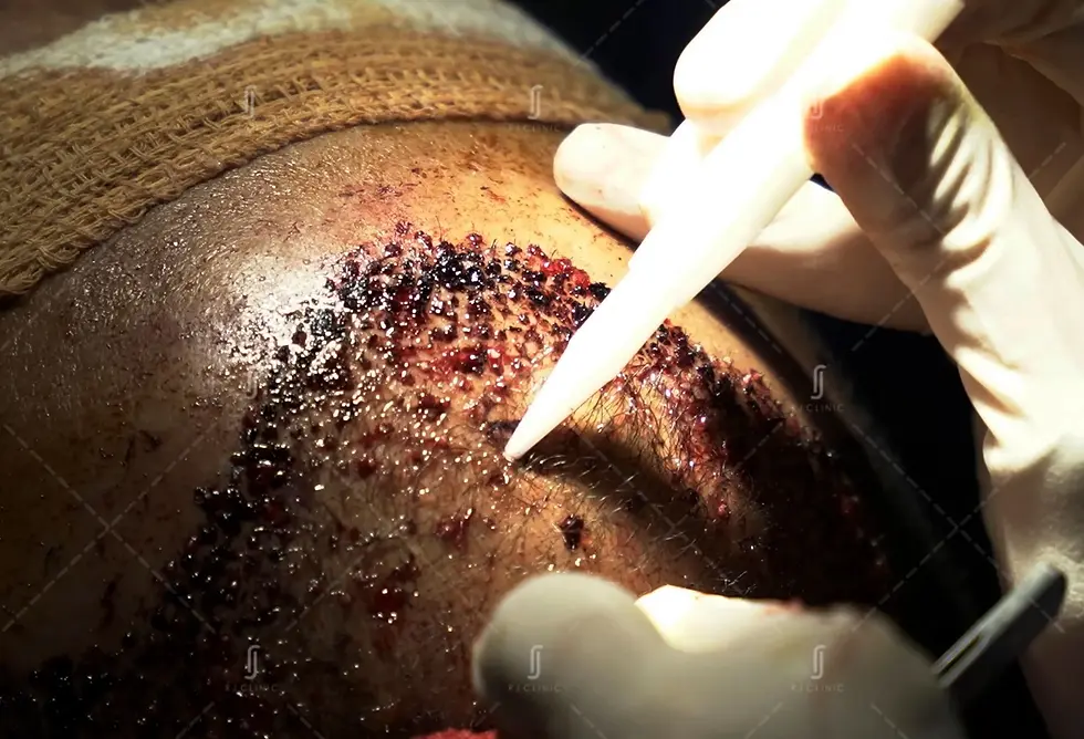 Precision graft placement during hair transplant at RJ Clinic