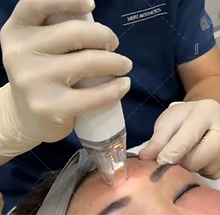 rf-microneedling-acne-scar-rj-clinic-kl_