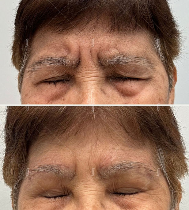 Botox Treatment for glabella at RJ Aesthetic Clinic