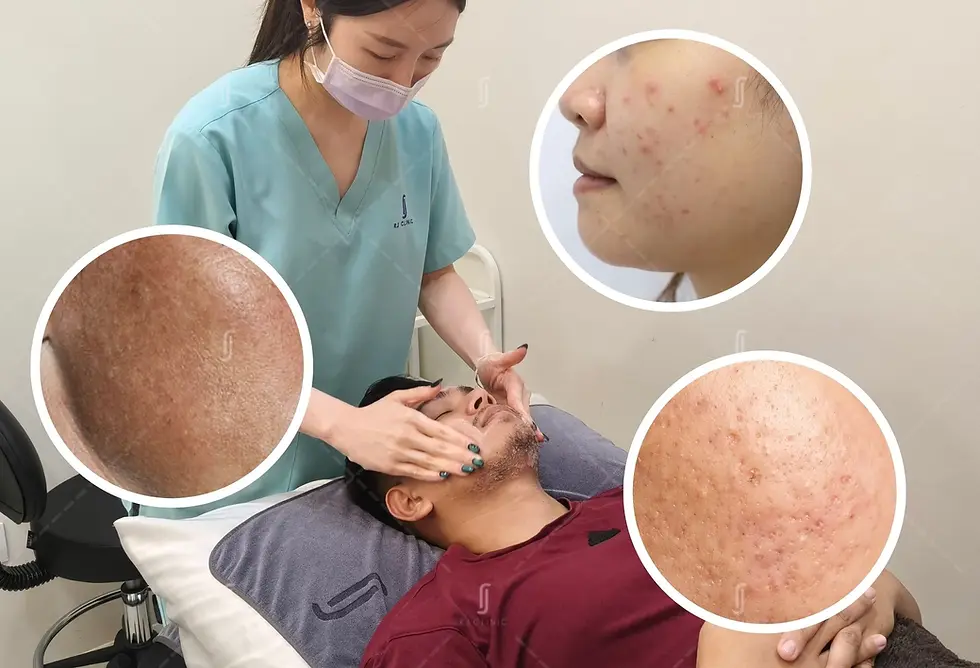 Acne skin consultation and treatment planning at RJ Clinic Kuala Lumpur for personalized skincare solutions