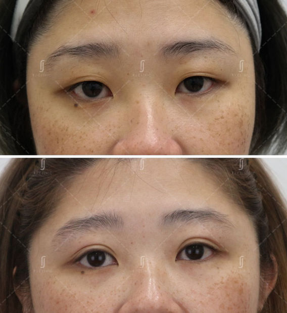 Plexr plasma double eyelid tightening treatment at RJ Clinic