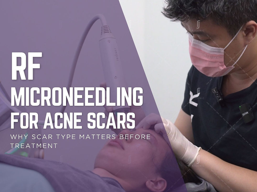 RF microneedling for acne scars at RJ Clinic