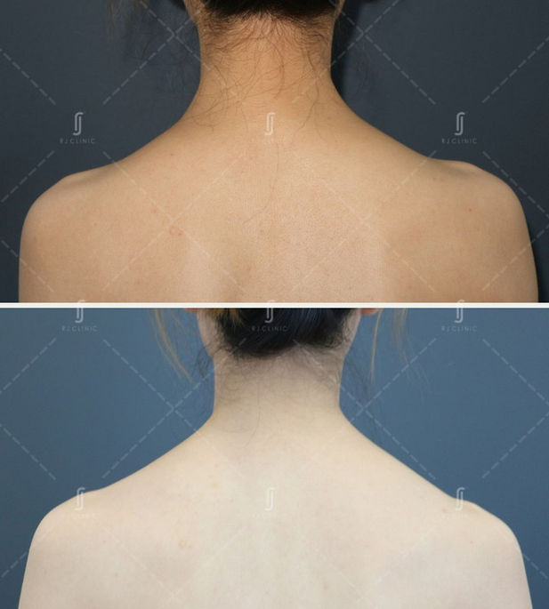 Botox Treatment for shoulder at RJ Aesthetic Clinic