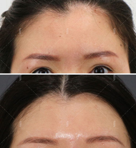 Plexr plasma mole removal treatment at RJ Clinic