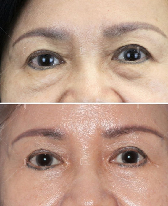 Before and after eye bag removal surgery at RJ Clinic Malaysia – female patient with smoother under-eye area and lifted lower lids.