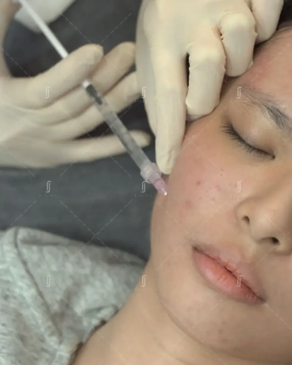 RJ Clinic chin filler treatment in Kuala Lumpur for V-shape face contour and projection enhancement