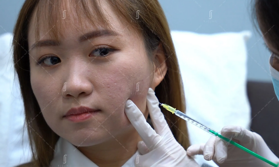 RJ Clinic jawline filler injection treatment for sharper facial contouring and V-shape jawline in KL
