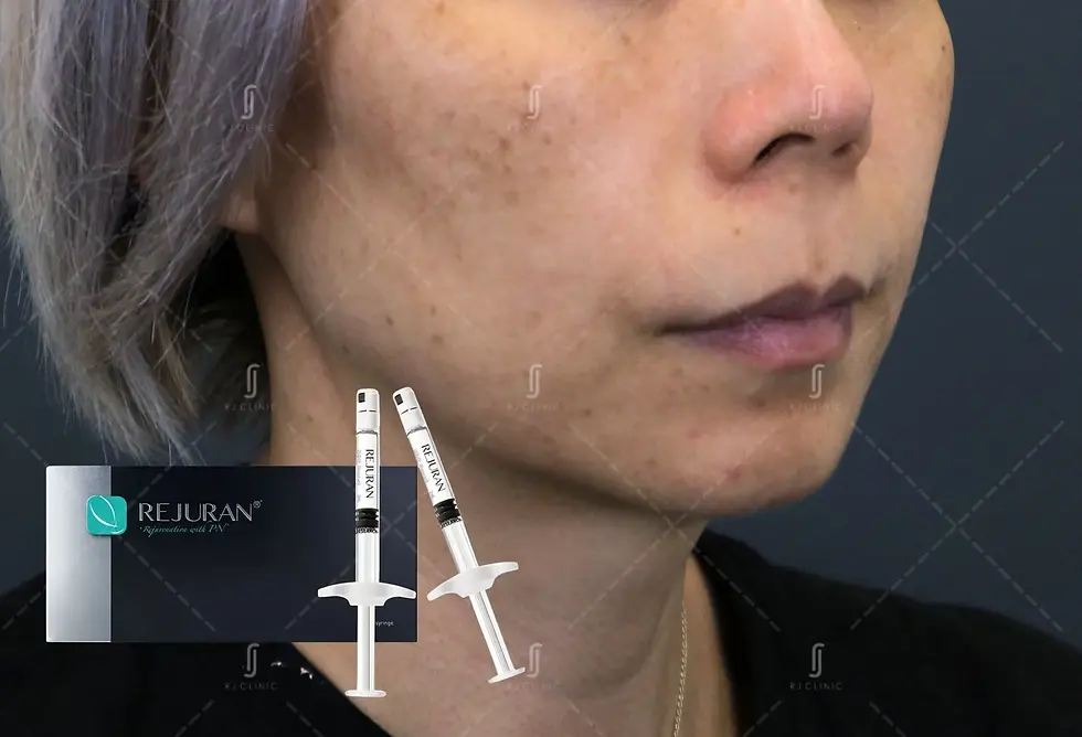 Rejuran Healer acne scar improvement results at RJ Clinic Kuala Lumpur
