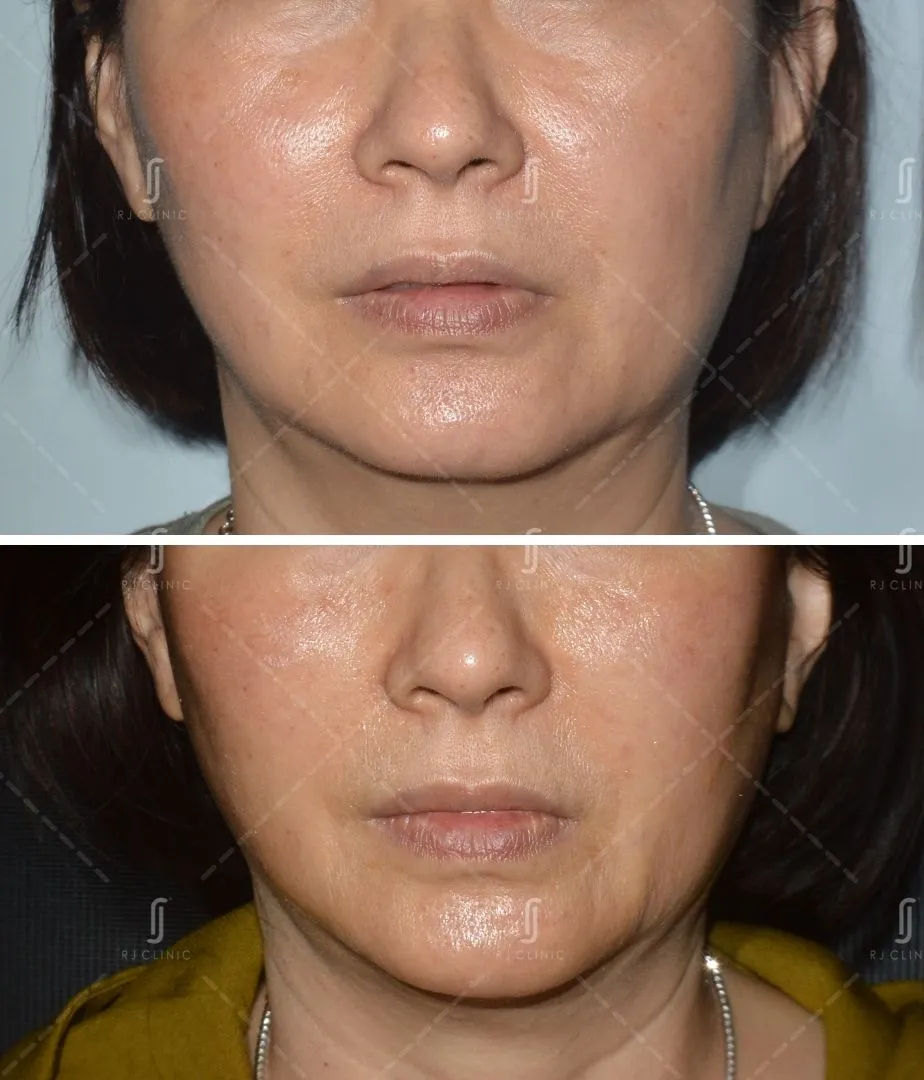Before and after Ultherapy Prime results at RJ Clinic showing lifted jawline and improved skin firmness