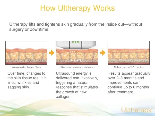 How Ultherapy works in face lifting explained at RJ Clinic