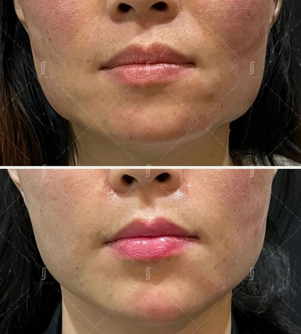 Botox Treatment for masseter at RJ Aesthetic Clinic