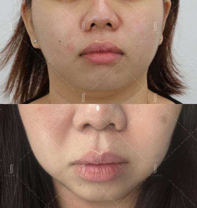 Ultherapy Prime for tighter skin in Malaysia – real results