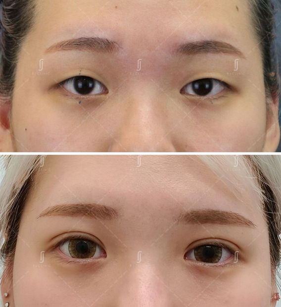 Plexr plasma double eyelid tightening treatment at RJ Clinic