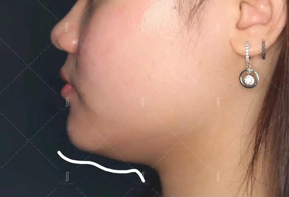 RJ Clinic fat reduction treatment injection in Kuala Lumpur for body contouring results