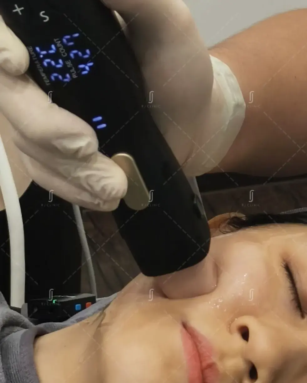 Density RF procedure for face contouring at RJ Clinic