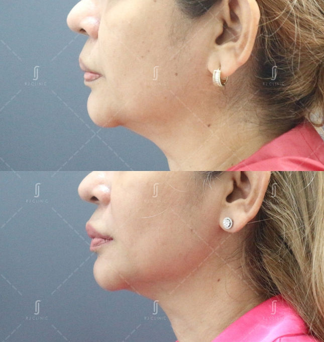 Face contour tightening with Ultherapy Prime – RJ Clinic KL