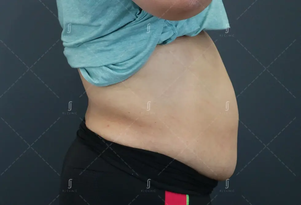 Stubborn abdominal fat before slimming treatment at RJ Clinic