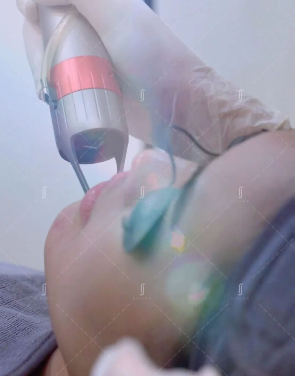 Laser melasma treatment using pico technology at RJ Clinic Malaysia