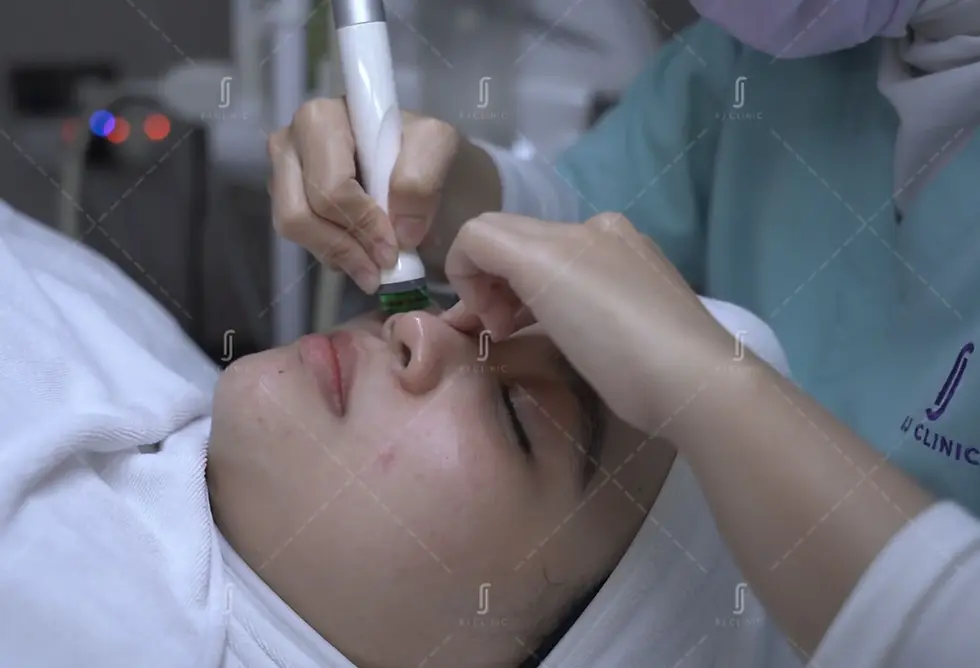 Laser skin rejuvenation treatment at RJ Clinic Malaysia for pigmentation and acne scars