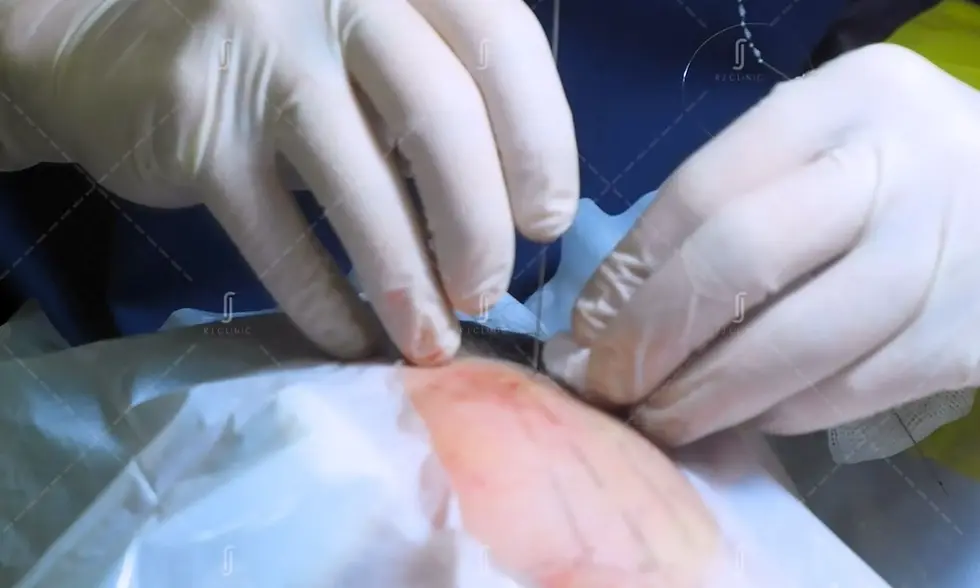 RJ Clinic doctor performing non-surgical face contouring treatment in TTDI using threadlift for jawline sculpting