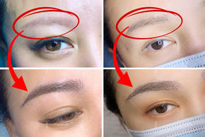Instabrow eyebrow transplant results at RJ Clinic