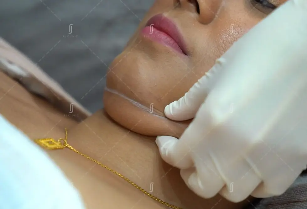 RJ Clinic Ultherapy jawline lifting treatment in Kuala Lumpur for non-surgical V-shape face tightening