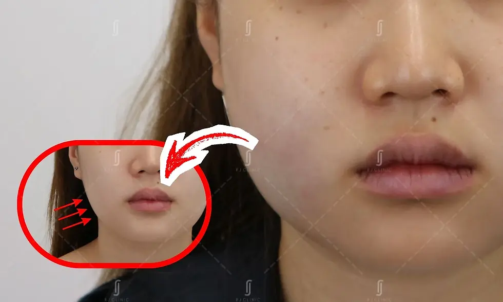 RJ Clinic non-surgical buccal fat removal alternative treatment for V-shape face slimming in Malaysia
