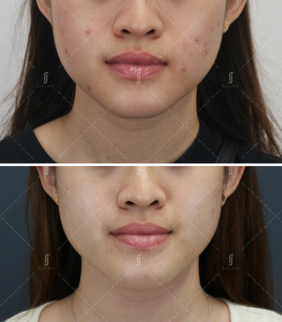 Acne treatment done at RJ Clinic by LCP certified doctor Dr Renee