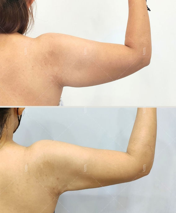 Upper arm contouring with Accusculpt laser lipo – RJ Clinic Malaysia