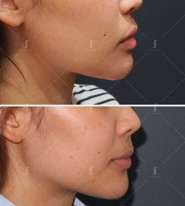 Botox Treatment for chin at RJ Aesthetic Clinic