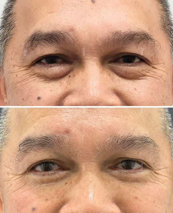 Before and after eye bag removal surgery – male patient at RJ Clinic with natural correction of lower eyelid puffiness.
