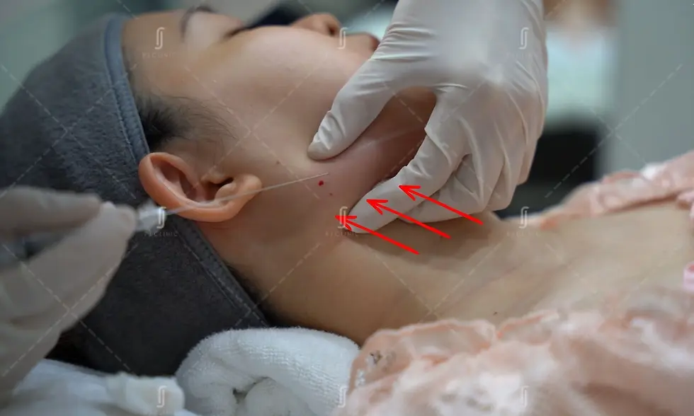 RJ Clinic doctor performing professional face slimming treatment in KL for natural V-shape jawline contouring