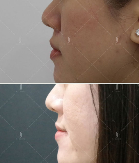 Cheek filler treatment done at RJ Clinic