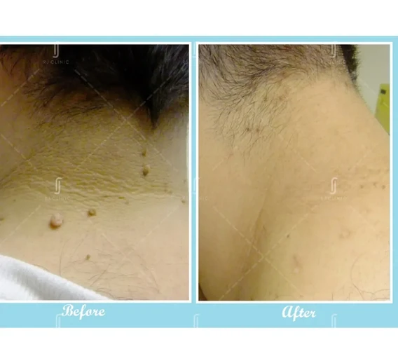 Skin tag removal at RJ Clinic