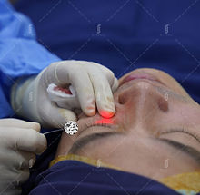 rj-clinic-eyebag-laser-ativo.jpg