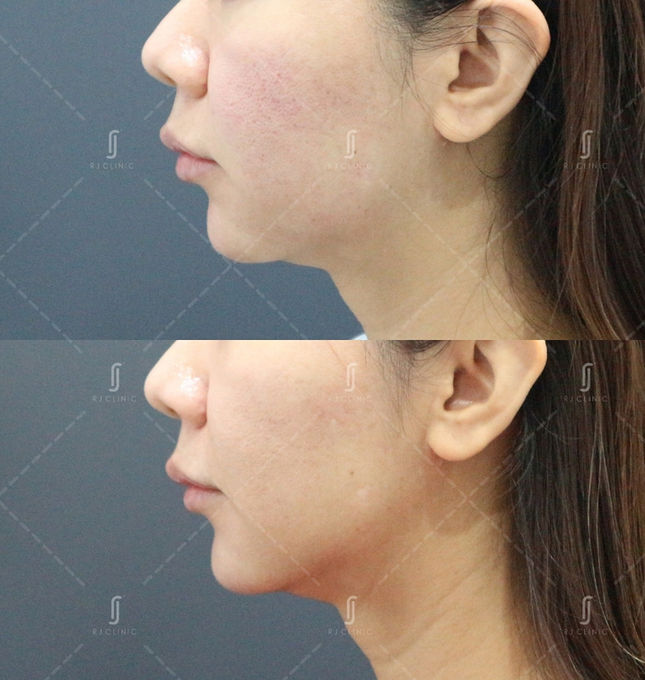 Before and after Ultherapy Prime face lift at RJ Clinic Malaysia
