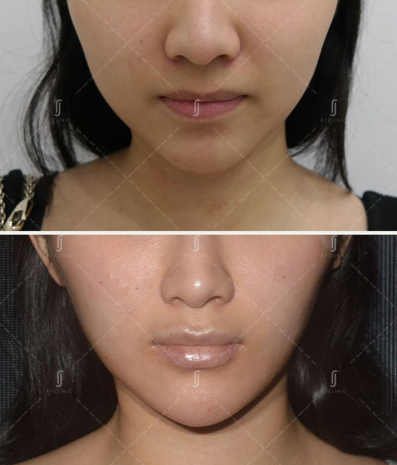 Chin filler treatment done at RJ Clinic