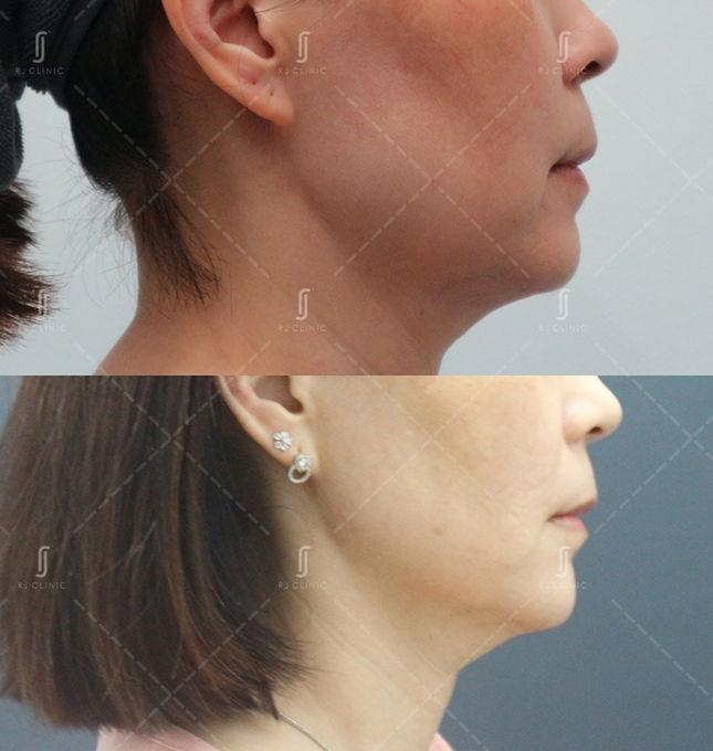 Real Ultherapy Prime patient results at RJ Clinic Kuala Lumpur